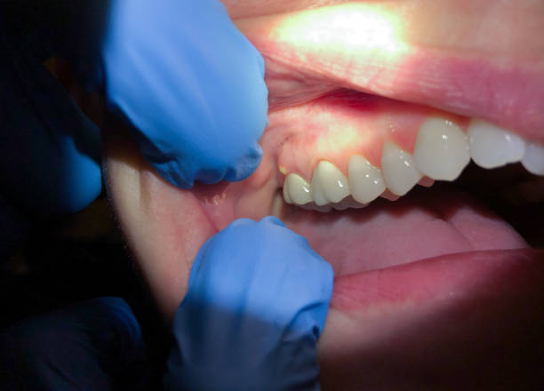 Best Emergency Tooth Extraction in Rockville, MD